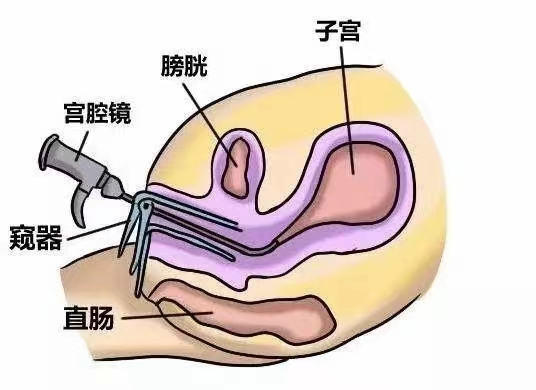 问诊小贴士| 关于宫腔镜检查，你了解多少？（上篇）