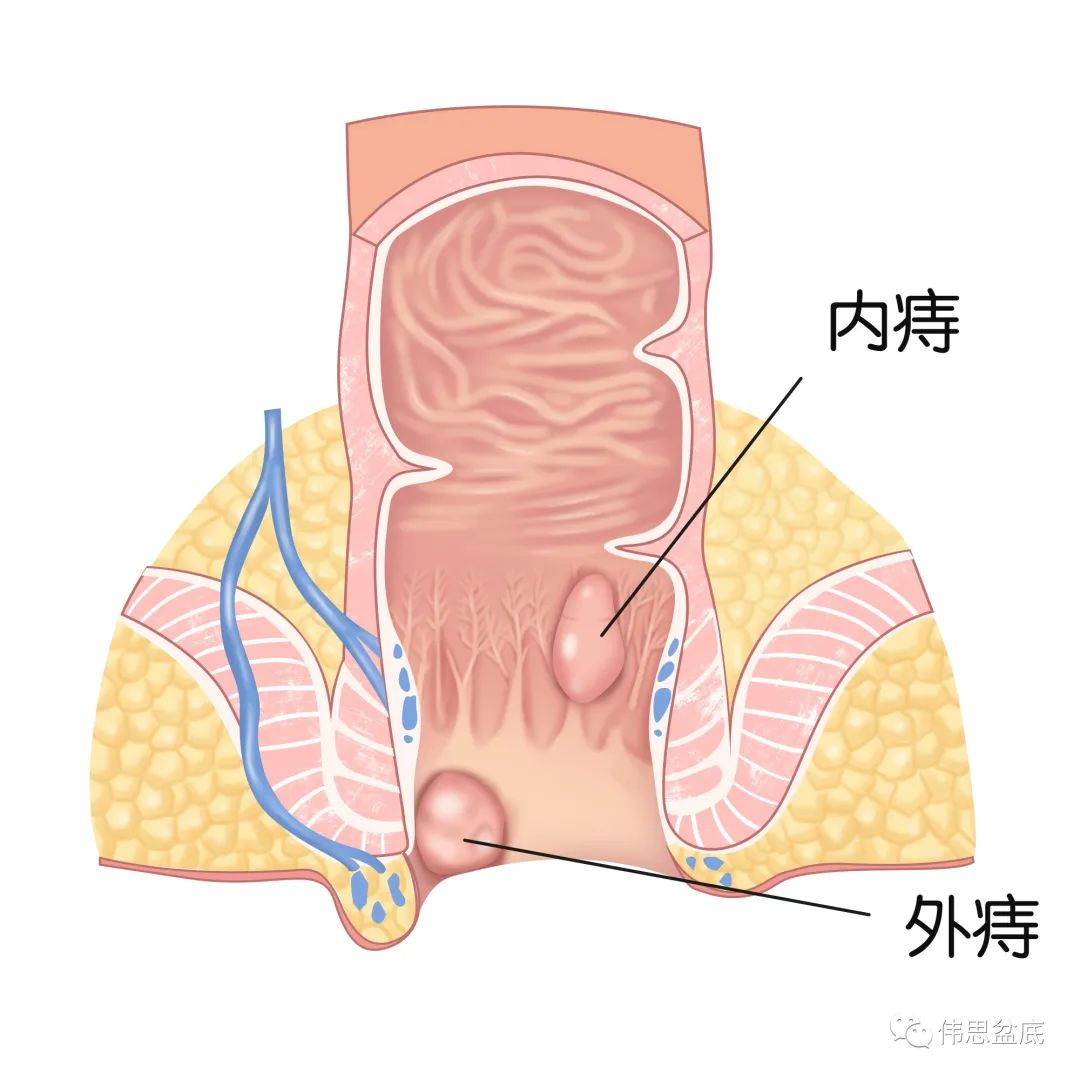 转载：摸到下体多出来一块肉，怎么回事？