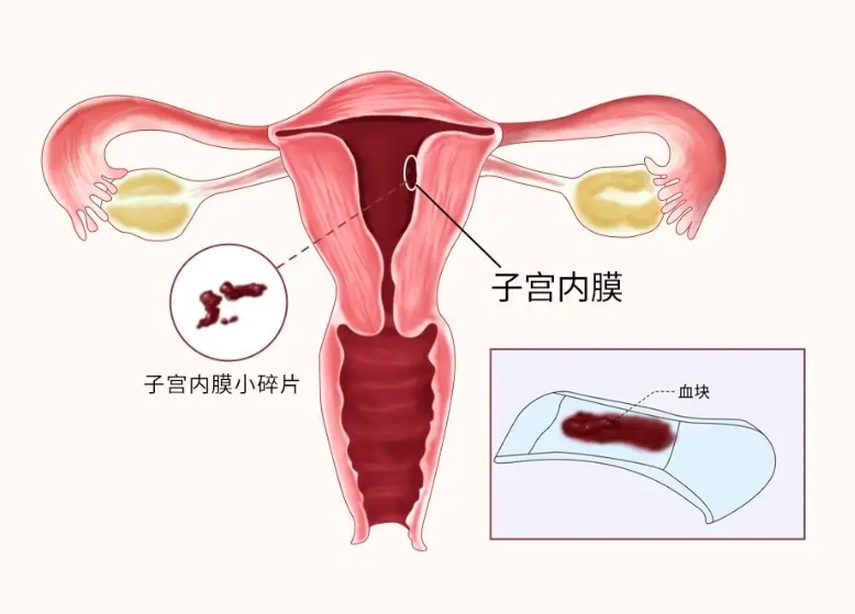 转载：有生育需求子宫内膜息肉患者的管理方案