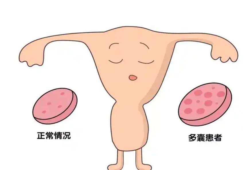 转发：多囊卵巢综合征合并胰岛素抵抗诊治专家共识