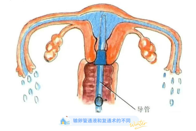 「试管婴儿」输卵管通液和输卵管复通术的区别？