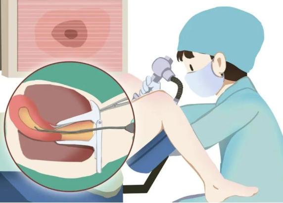 「试管婴儿」宫腹腔镜手术是试管周期中必须要做的吗？