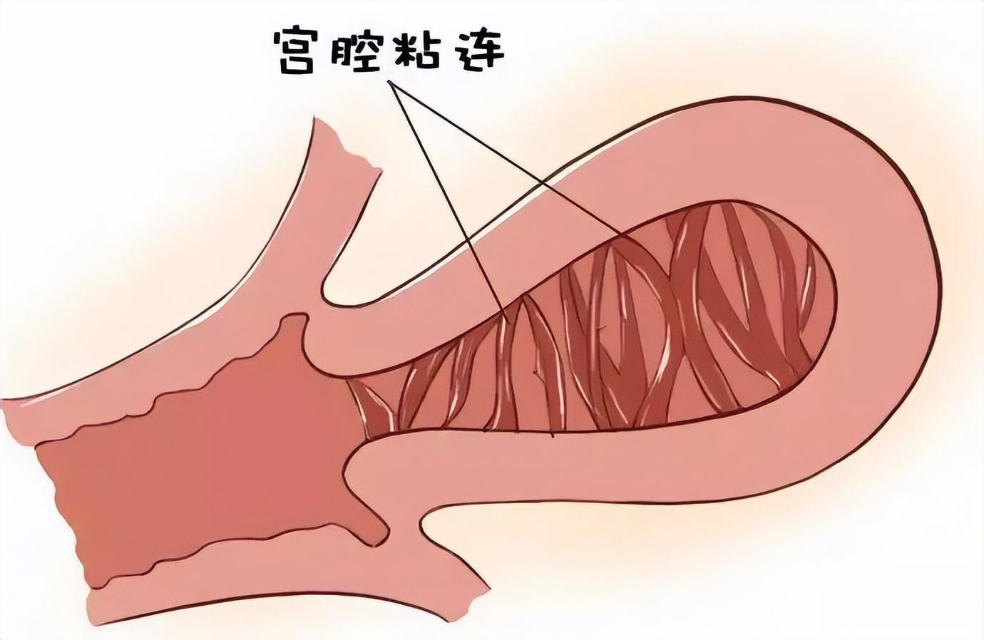 宫腔粘连案例分享|汪玄晖主任：海口玛丽医院的“子宫守护者”